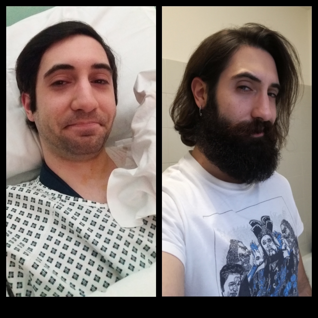 From February Till Today. Please Take Note Of The Extremely with Beard For Weak Chin