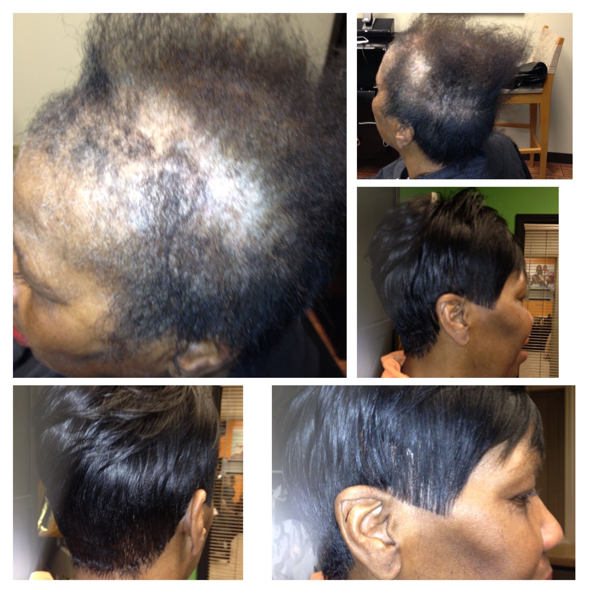 Full Custom Sewin 'no Glue' Natural Looking Sewin Thinning throughout Black Hairstyles With Hair Loss