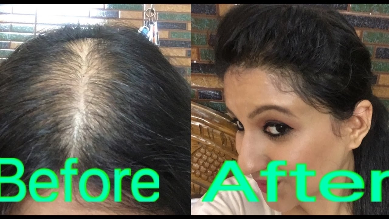 How To Style Your Hair In Partial Alopecia To Hide Bald Spots pertaining to Hairstyles To Cover Alopecia